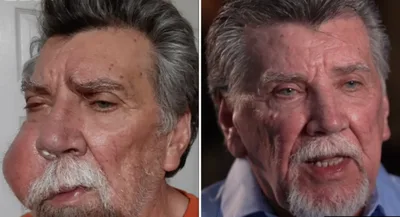 Tumor se dissolve milagrosamente e homem é curado por Deus
