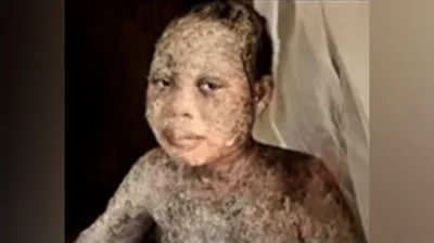 Família sofre ataque com ácido por deixar islã e se converter a Jesus