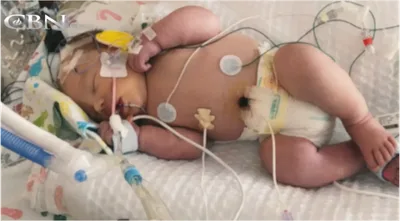 Desenganado, bebê sobrevive a parto complicado e pais falam em milagre