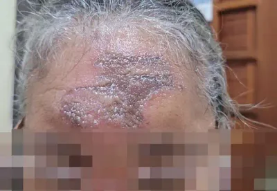 Após serem ungidos na testa, cinco fiéis tem queimaduras na pele