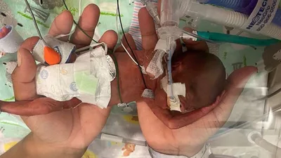 Com 1% de chance de vida, bebê que nasceu com 21 semanas sobrevive após oração da mãe