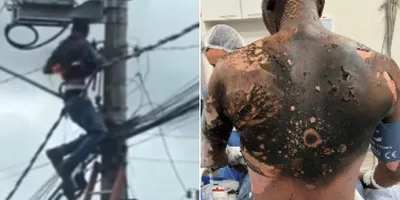 Eletricista volta à vida após sofrer descarga elétrica de 13 mil volts: \"Sou um milagre\"