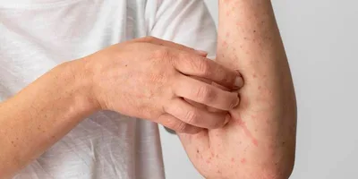 Quais são os principais sinais de alergia alimentar?