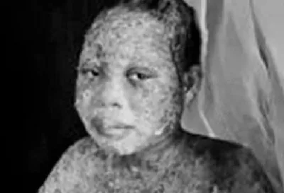 Família sofre ataque com ácido por deixar o Islã e aceitar a Jesus Cristo