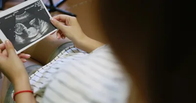 Jovem desiste de abortar gêmeos ao ouvir o coração dos bebês batendo