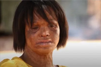 Mulher queimada por marido encontra cura em Jesus