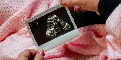 'Lei do Batimento Cardíaco' salva 23.000 bebês do aborto, na Flórida