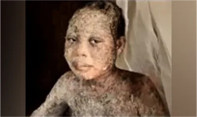 Pai, esposa e filha cristãos são atacados com ácido por muçulmanos