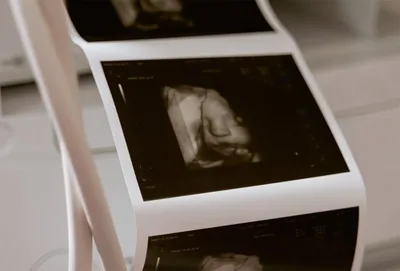 MP pede uso de anestesia em bebês abortados com cloreto de potássio