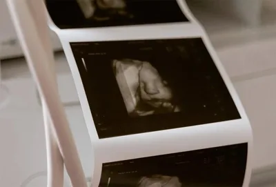 Tribunal permite aborto de bebê de 35 semanas por ser deficiente