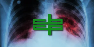 Let’s end TB, panawagan ng CBCP