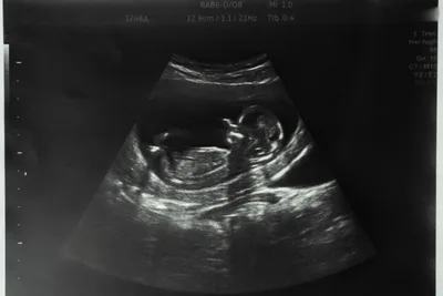 Extending 'DIY' Home Abortions 'puts women in greater danger''