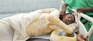 Christian Boy, 14, Clinging to Life after Burn Attack in Eastern India - Morningstar News