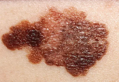 Melanoma Vaccine Success Sparks Hope for Broader Cancer Treatment