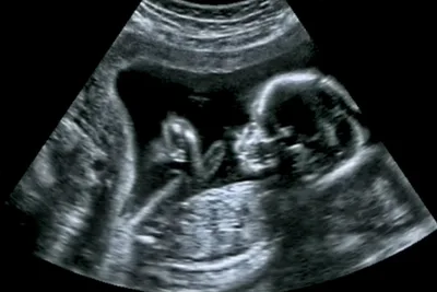 Physician blasts Justice Sonia Sotomayor for 'dead brain people' comment about fetal pain