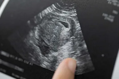 Heartbeat abortion bans move forward in Tennessee, Georgia