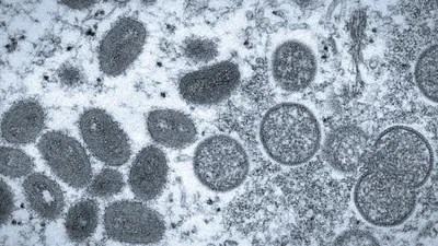 WHO Convenes Emergency Committee as Monkeypox Revealed to Be Primarily a Sexually Transmitted Disease