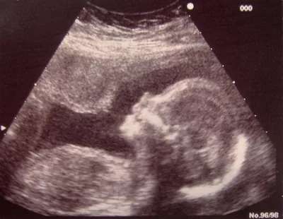 Abortion providers adjust to new federal funding rules | Baptist Press