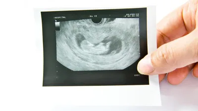 Supreme Court Allows Texas Bill Banning Abortions Once a Heartbeat is Detected to Remain in Place