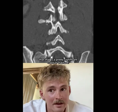 Forrest Frank Shows Proof of Broken Back, Rapid Healing: 'Did we see a miracle?''