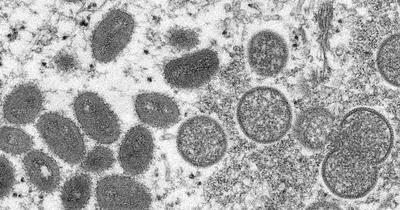Monkeypox in over half of U.S. states