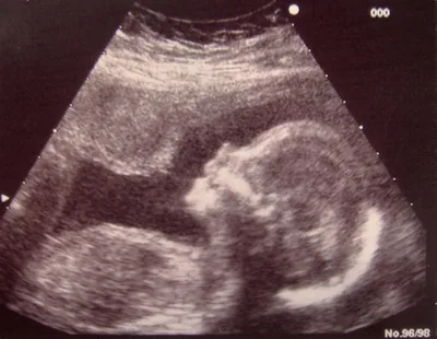 Chemical abortions on hold in Arkansas | Baptist Press