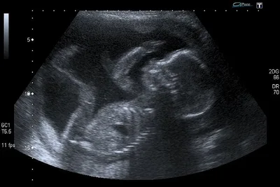 Supreme Court poised to hear biggest challenge to Roe v Wade in 48 years
