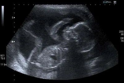 Alabama abortion ban blocked in federal court