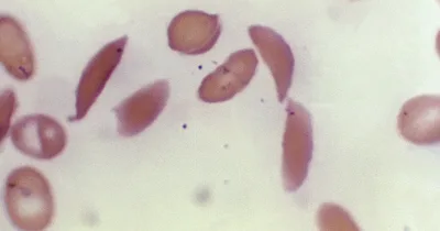 FDA approves two genetic treatments for sickle cell disease