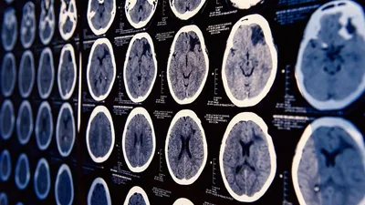 'I'm Stupid. I'm Crazy': Domestic Abuse Victims Could Have Brain Damage