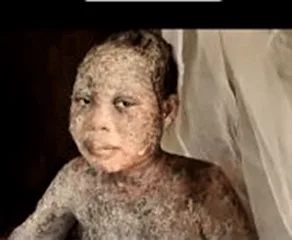 Family Sprayed with Acid for Leaving Islam - Morningstar News
