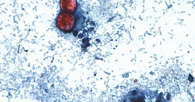 Two Michigan Deaths First of Multistate Cyclospora Outbreak