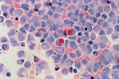'Remarkable' Cancer Treatment Study Shows Stunning Results: 'The First Time This Has Happened'