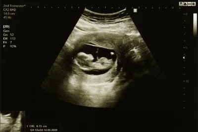 Facility-Based Abortions Drop 30% in North Carolina after 12-Week Abortion Ban, Data Show