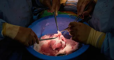 Pig Hearts Successfully Transplanted—Twice