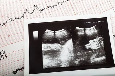 Planned Parenthood Asks Court to Block 6-Week Abortion Ban in Iowa