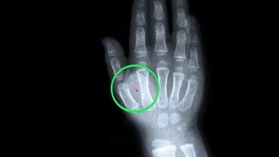 British Microchip Implant Takes Hand-Swipe Payments to Next Level, Along with End Times Prophecy Concerns