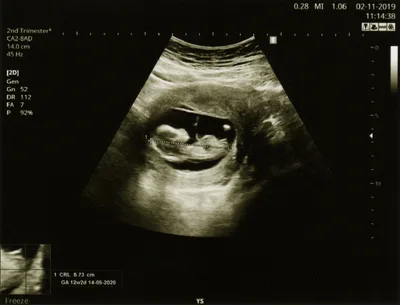 Wyoming Advances a New Abortion Ban to Replace Blocked ‘trigger law’