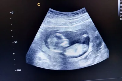 Bishop Barron: True dialogue impossible if Catholic Dems won’t protect babies who survive abortion