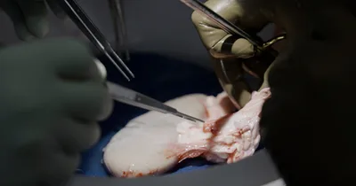 Pig Kidney Works in Man’s Body for More Than a Month