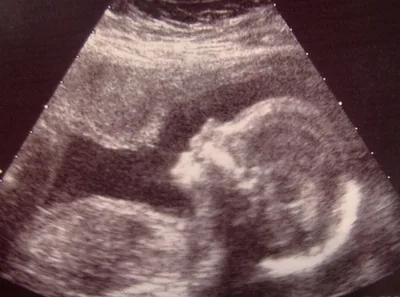 Ky. bills to protect unborn babies progress | Baptist Press