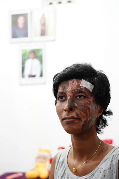 Woman who survived Sri Lanka bombings with terrible burns becomes bride this Easter season
