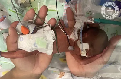 World's most premature baby was born 3 weeks before UK abortion limit