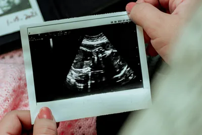 Unprecedented: Aborted Baby Wins Wrongful Death Lawsuit