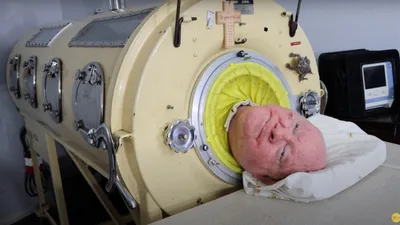 Paul Alexander, Confined 72 Years in Iron Lung, Spoke of 'God's love' before Death