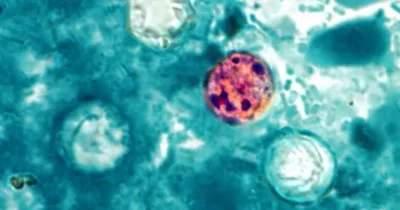 Michigan Outbreak of Parasitic Infection Sickens More Than 1,200