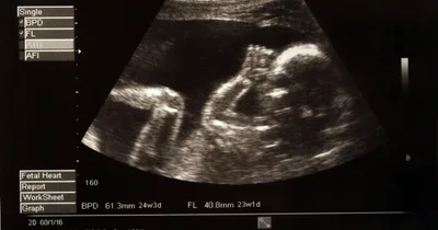 Britain to Vote on Decriminalizing Abortion