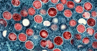 One Confirmed Case of New Mpox Variant in Europe