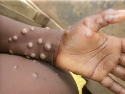 As Monkeypox Spreads, Global Organizations Mobilize Faith Networks To Fight Stigma