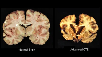 'No Safe Blow to the Head': Why One Season of Childhood Football Likely Means Irreversible Brain Damage